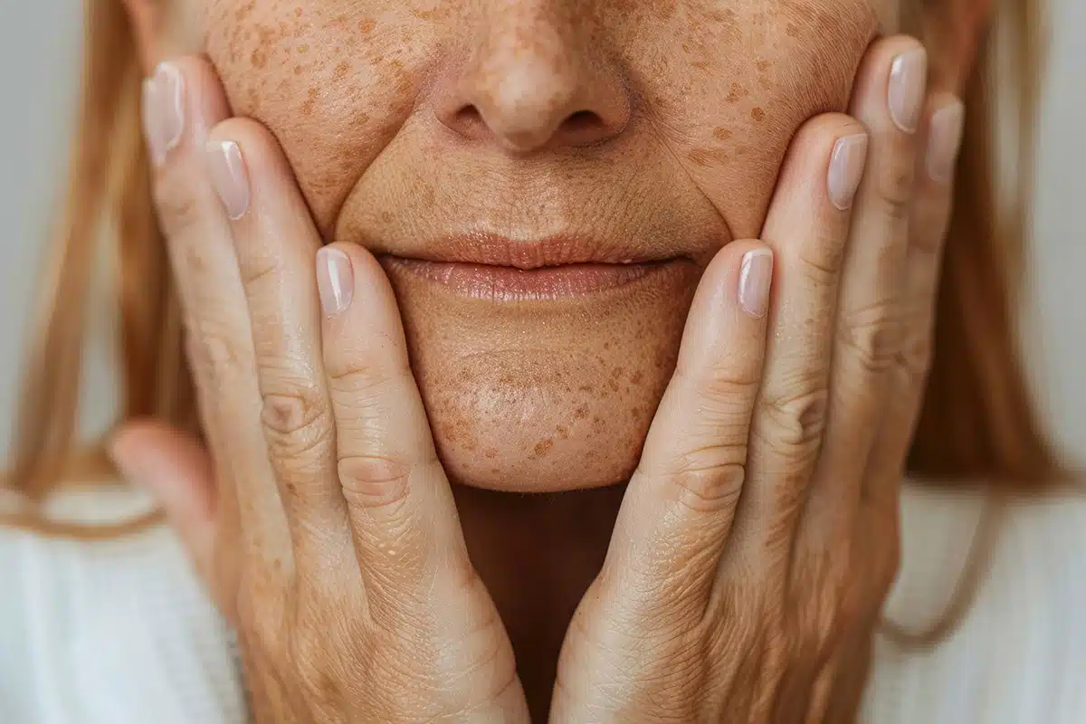 A woman with a close up of her hands on her face with liver age spots