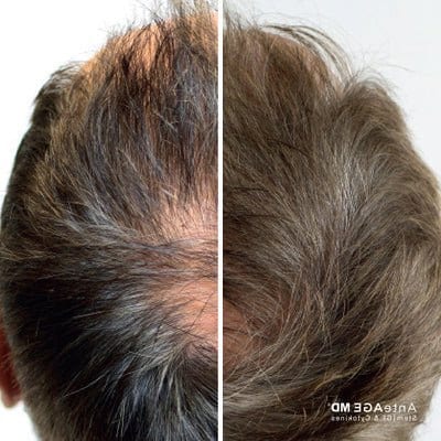 anteage Hair before and after sempre spa ()