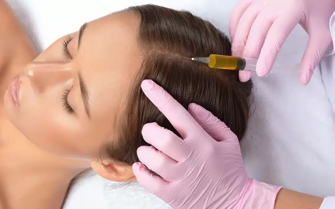 PRP for Hair Loss