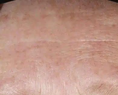 DiamondGlow Facial 2 after treatments