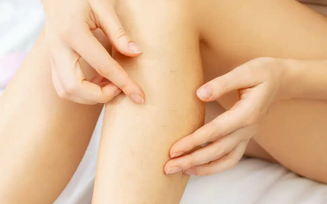 Epilfree vs Laser Hair Removal