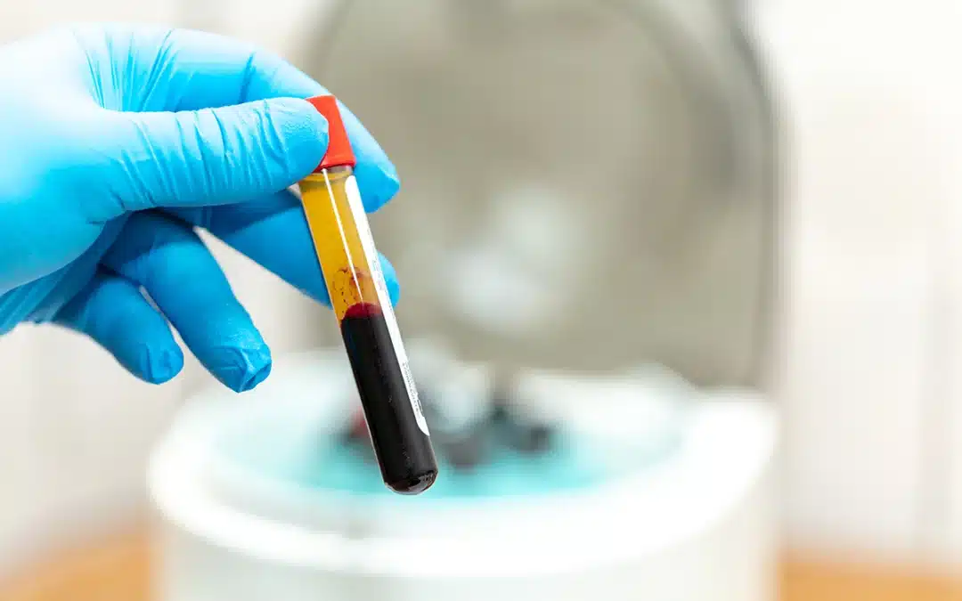 Microneedling with PRP (Platelet Rich Plasma)