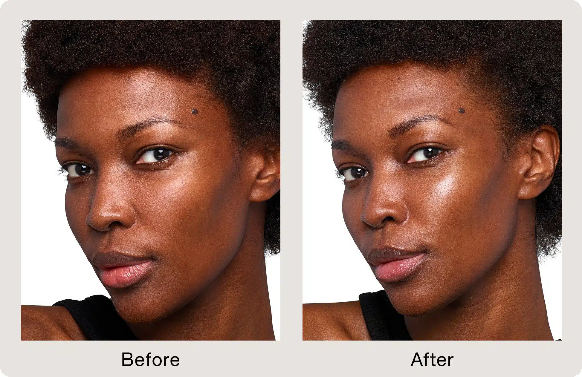 Skinvive Juvederm before and after photo