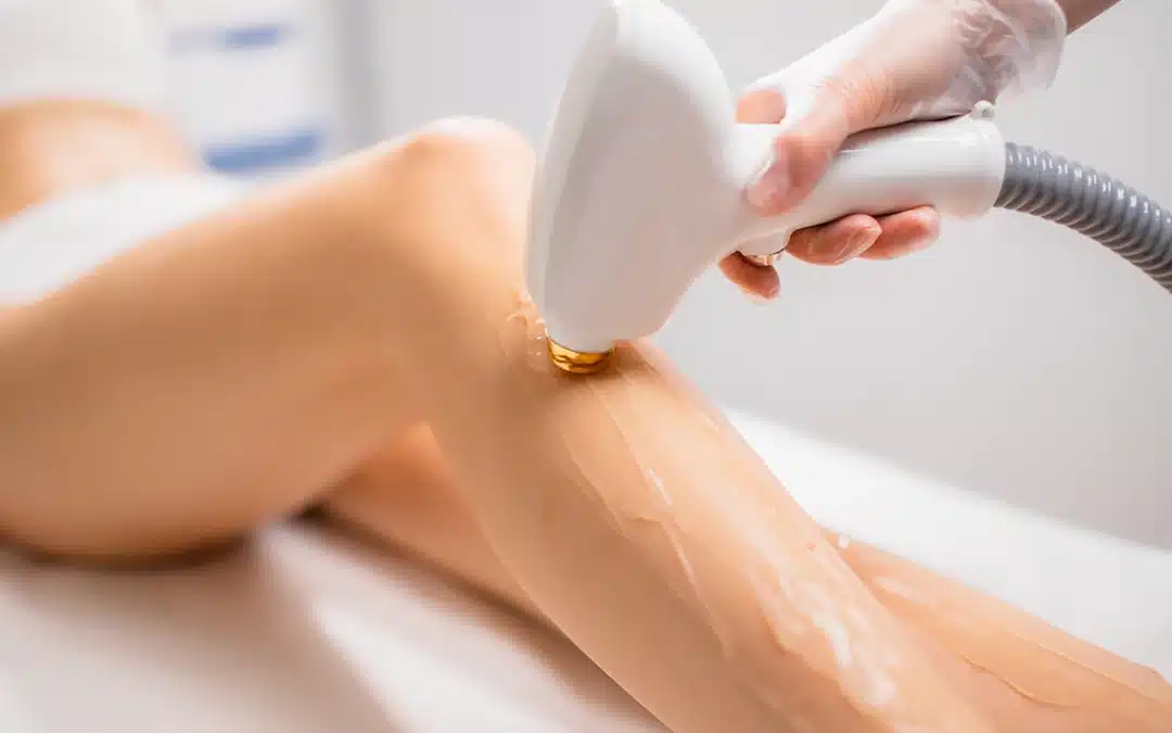 Laser Hair Removal